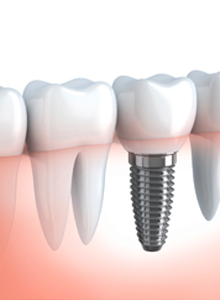 Tu implante con clínica dental Antín